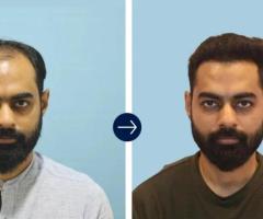Allroots - Hair Transplant Clinic in India | Hair Transplant Clinic