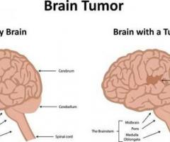 Brain Cancer Causes, Symptoms & Types | Medanta