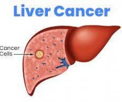 Liver Metastases - Causes, Symptoms & Treatment | Medanta