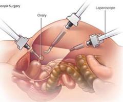 Minimally Invasive Laparoscopy for Infertility at Prem Hospital