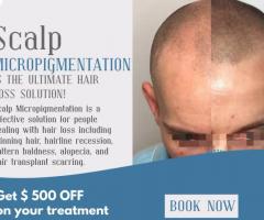 Fast and Guaranteed Results with Scalp Masters Atlanta's SMP Treatment
