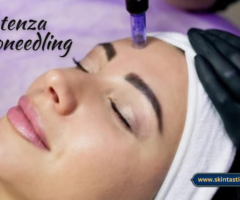 Advance Potenza Microneedling in Riverside