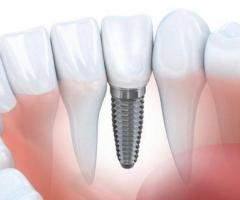 Dental Implant in Ramanathapuram