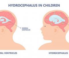 Hydrocephalus - Causes, Symptoms & Treatment | Medanta