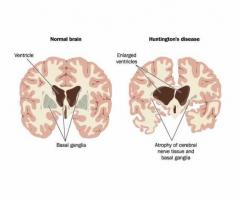 Huntington's Disease: Symptoms, Causes & Treatment | Medanta