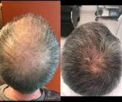Best Hair Therapy For Hair Loss Las Vegas, NV
