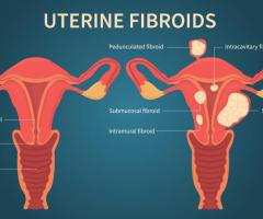 Fibroid Removal or Fibroids Surgery | USA Fibroid Centers