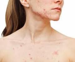 Acne Scar