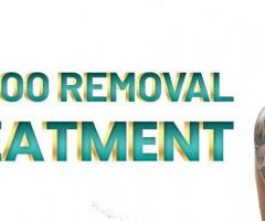 Laser Tattoo Removal in Islamabad - Rehman Medical Center