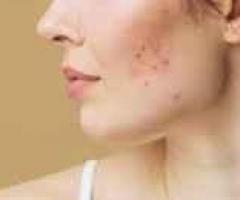 Get Effective Homeopathic Treatment for Acne - 24/7 Homeopathy