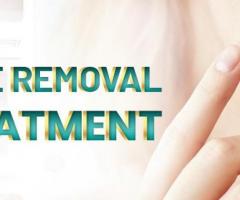 Laser Mole Removal in Islamabad - Rehman Medical Center