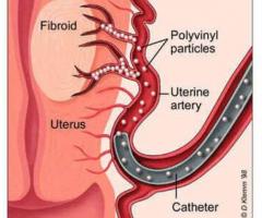 What are the benefits and side effects of Uterine Artery Embolization | Medanta