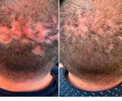 GFC Treatment in Thrissur: Advanced Hair Restoration for Healthy Hair Growth - 1