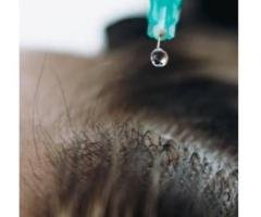 GFC Treatment in Thrissur: Advanced Hair Restoration for Healthy Hair Growth - 2