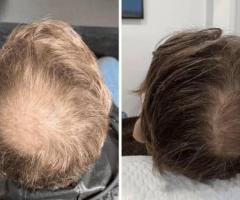 Hair Loss Treatment Thrissur: Advanced Solutions for Healthy Hair Growth - 1