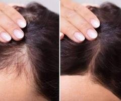 Hair Loss Treatment Thrissur: Advanced Solutions for Healthy Hair Growth - 2