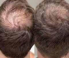 Hair Loss Treatment Thrissur: Advanced Solutions for Healthy Hair Growth - 3