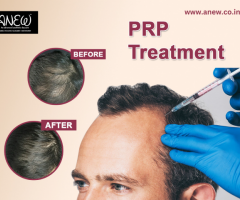 Revitalize Your Hair with PRP Treatment in Bangalore - Book Now