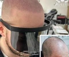 What Is the Recovery Time After Scalp Micropigmentation London?