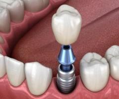 Affordable Dental Implants in Euless, TX | Restore Your Smile Today