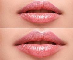 Lip Augmentation Cost : Is It Worth the Investment?