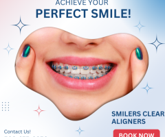 What are Smilers Clear Aligners ?
