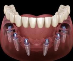 Restore Your Smile with Confidence: Dental Implants at Pleasant Dental