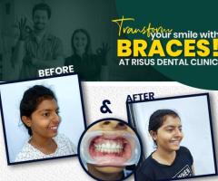 Advanced Pitts21 Braces & Orthodontic Care in ECIL,