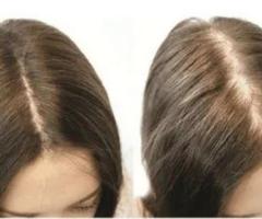 Hair Loss Treatment for Men and Women That Works