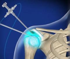 Shoulder Arthroscopy Surgeon in Delhi - Dr. Shekhar Srivastav