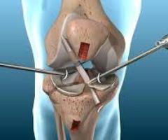 Best ACL Surgeon in Delhi | ACL Reconstruction | Dr Shekhar