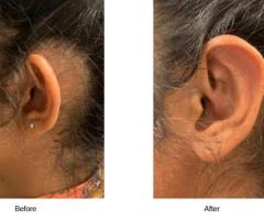 Ear plastic Surgery Cost in California