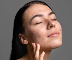 Acne Treatment in Lucknow