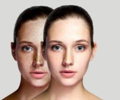 Pigmentation Treatment in Lucknow