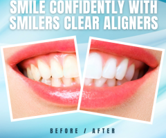 Are Smilers Clear Aligners Right for You ?