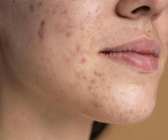 Acne Treatment in Lucknow