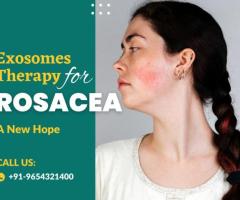 Exosomes Therapy for Rosacea: A New Hope