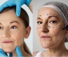 Natural-Looking Face Lift Surgery – Restore Youth Today