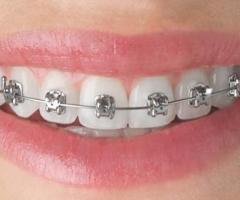 Fluoride Treatment for Braces Wearers: Why It’s Important