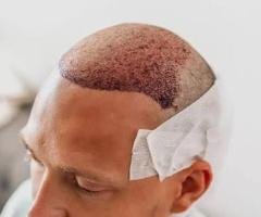 Best Hair Treatment in Thrissur: Advanced Solutions for Healthy and Strong Hair