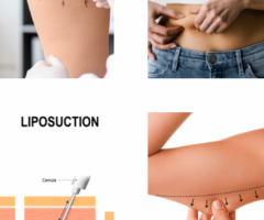 Liposuction in Scottsdale AZ