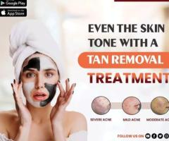 best Birthmark removal laser treatment in india