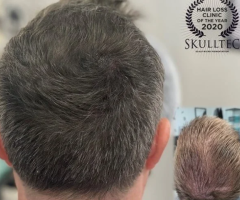 Skulltec : Scalp Micropigmentation In South East England