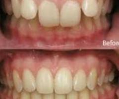 Expert Bite Correction Service in Murwillumbah – Restore Comfort & Alignment