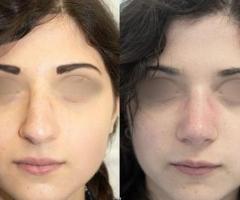 Chirurgia Plastica Naso