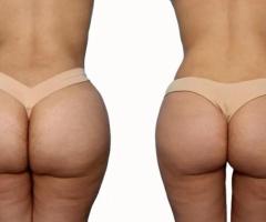 Brazilian Butt Lift (BBL) Surgery in San Francisco