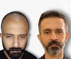 Best Hair Clinic in Kochi