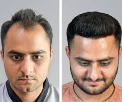 Best Hair Clinic in Kochi
