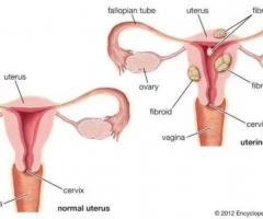 Understanding the Relationship: Are Fibroids Cancerous?