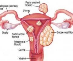 What is Exophytic fibroids?